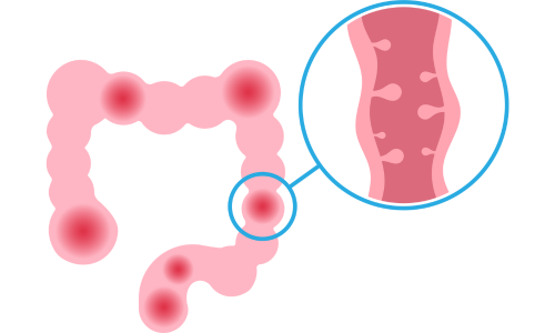 COLONIC DIVERTICULAR DISEASE: PREVENTION, TREATMENT & THE ROLE OF PROBIOTICS